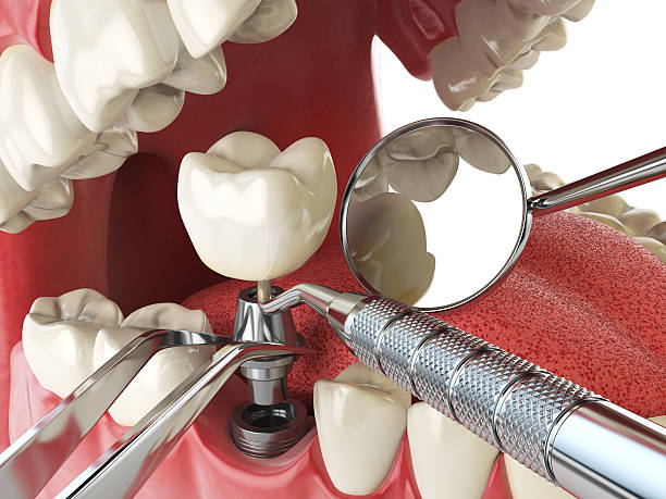Best Emergency Root Canal Treatment in Poquonock Bridge, CT